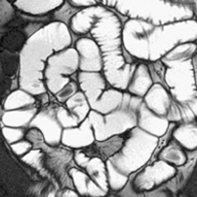 снимок МРТ тонкого кишечника с гидроусилением